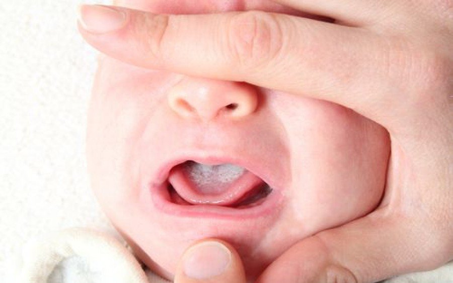 Chữa tưa lưỡi ở trẻ em