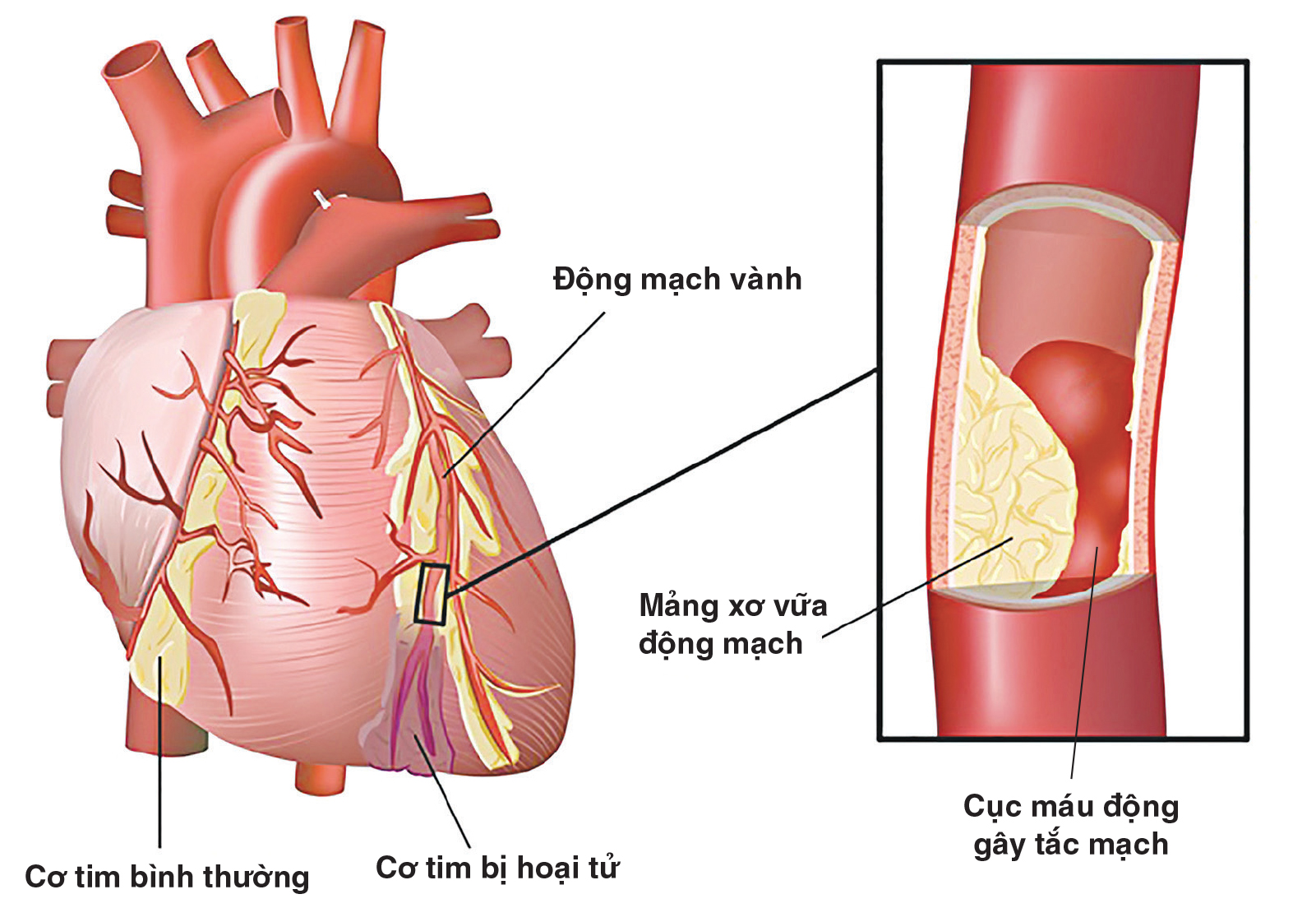 Bệnh động mạch vành ở cơ thể con người