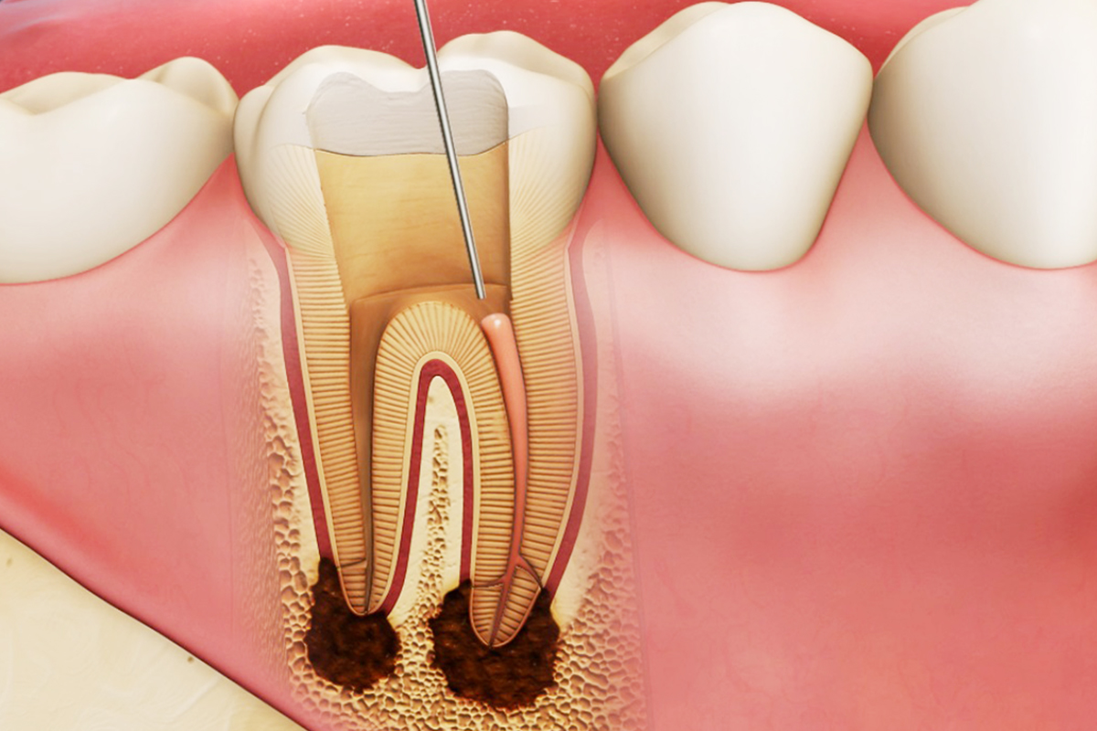 Viêm tủy răng là một bệnh lý của răng miệng