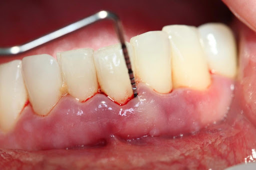 Viêm tủy răng gây ảnh hưởng lớn đến người bệnh